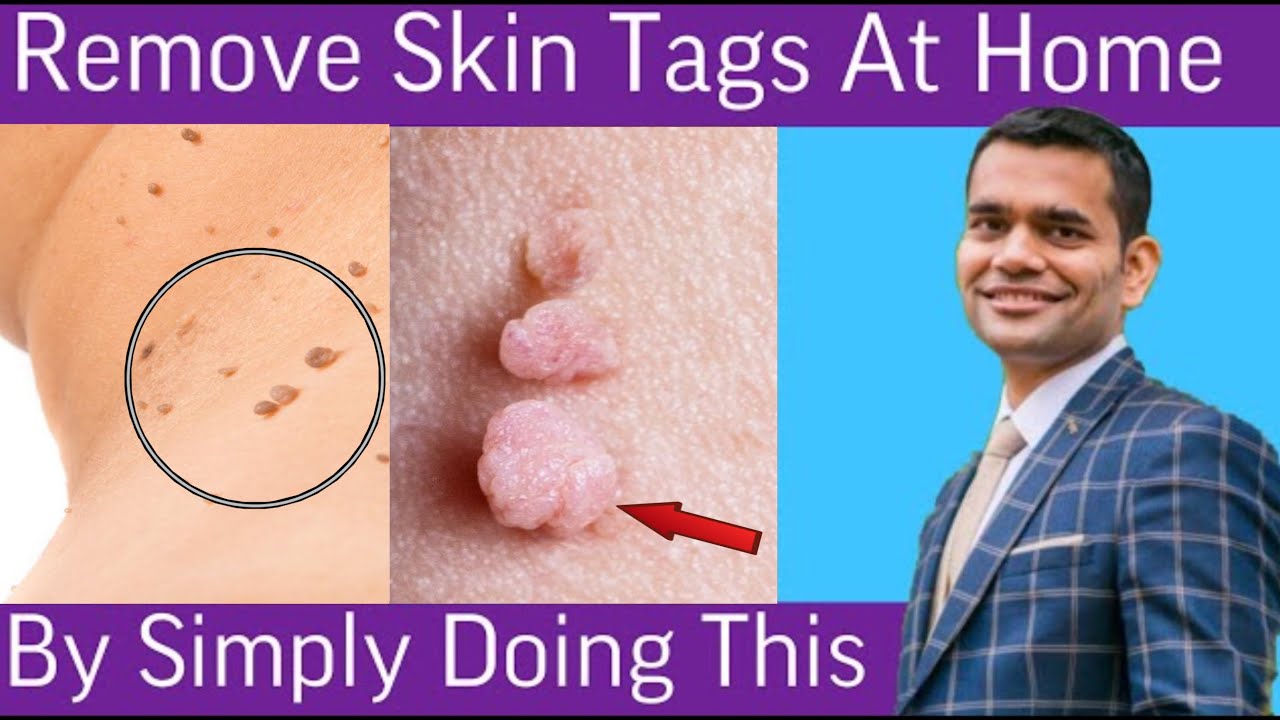 Simple Ways to Remove a Skin Tag at Home: Effective Techniques for 2025